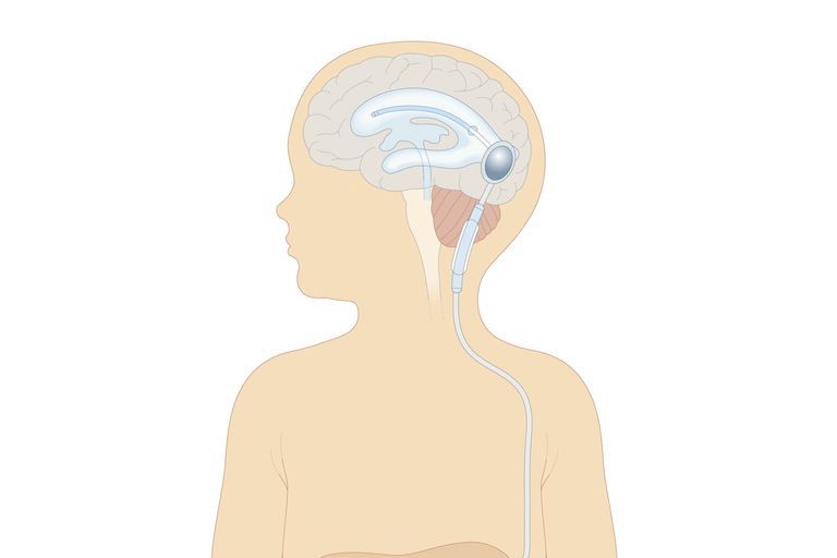 væske hjernen, placere shunt, almindelige type, almindelige type shunt, berørte ventrikel