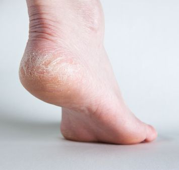 atopisk dermatitis, form eksem, kløende fødder, luftfugtighed eller