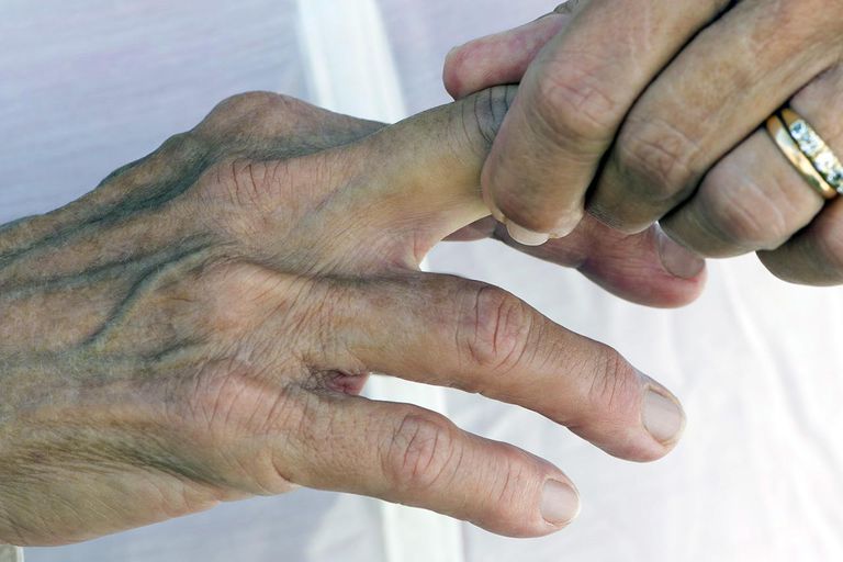 brud eller, fastklemte finger, eller forstyrrelse, eller osteopat, fastklemt finger