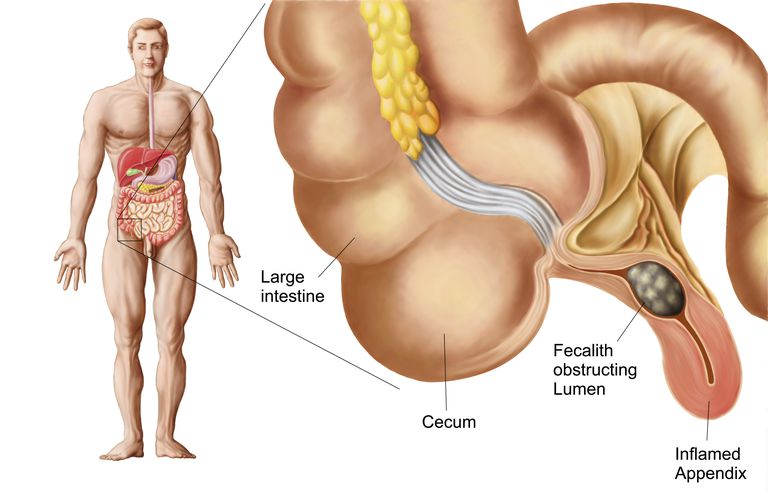 Crohns sygdom, ulcerativ colitis, ulcerøs colitis, risikoen Crohns, udvikle ulcerativ
