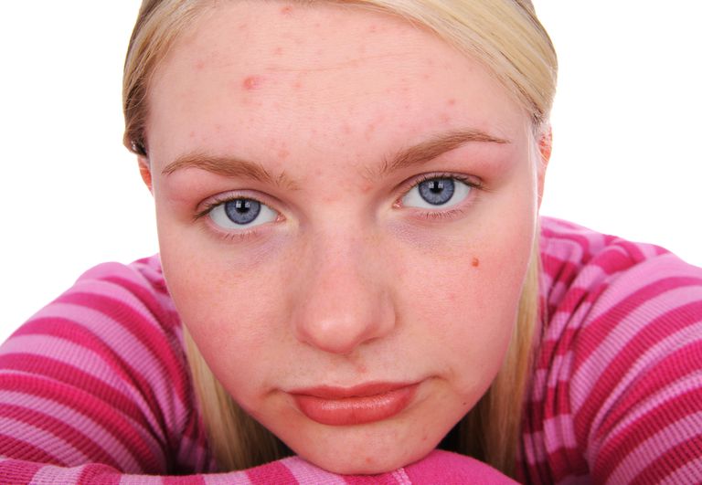 mild acne, form acne, acne mild, acne Nogle