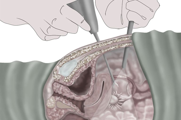 tubal ligation, efter proceduren, dage efter, laparoskopisk tubal