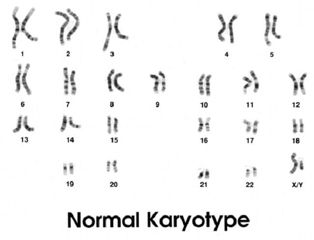 Downs syndrom, genetisk problem, ifølge National, karyotype afslører, syndrom kromosom, syndrom trisomi