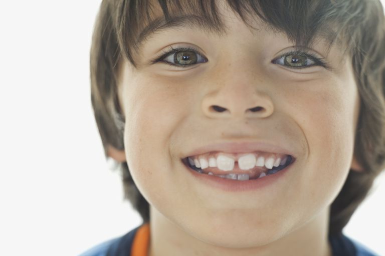 skæve tænder, barn skal, deres barn, ortodontiske bøjler, barns ansigts-, behandling skæve