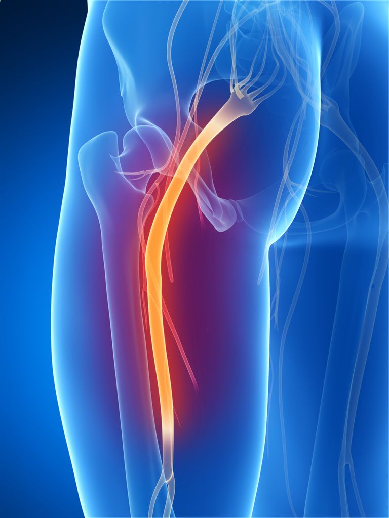 knust nerve, pinched nerve, eller sygdom, forårsager smerter, knækket nerve, løber langs