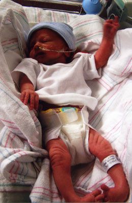 billede nyfødt, billede nyfødt barn, hjælp Ponseti-metoden, indad nedad, nyfødt barn, barn fodfod