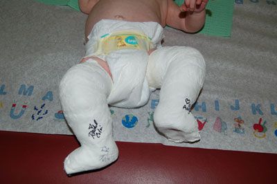 billede nyfødt, billede nyfødt barn, hjælp Ponseti-metoden, indad nedad, nyfødt barn, barn fodfod