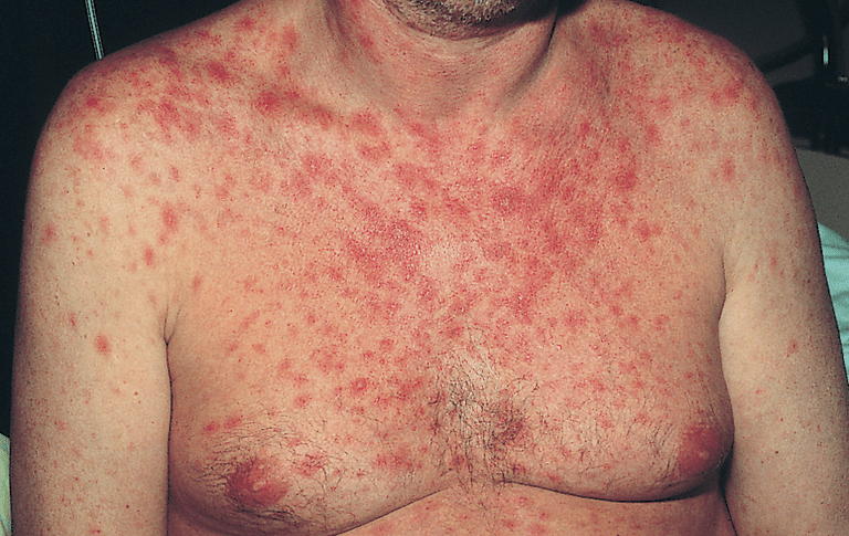 uger efter, Aktuelle kortikosteroider, alvorlige tilfælde, mere alvorlige, mere alvorlige tilfælde, Seborrheic dermatitis