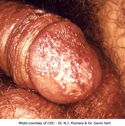 billede viser, Dette billede viser, dette billede, genital herpes, herpes læsioner
