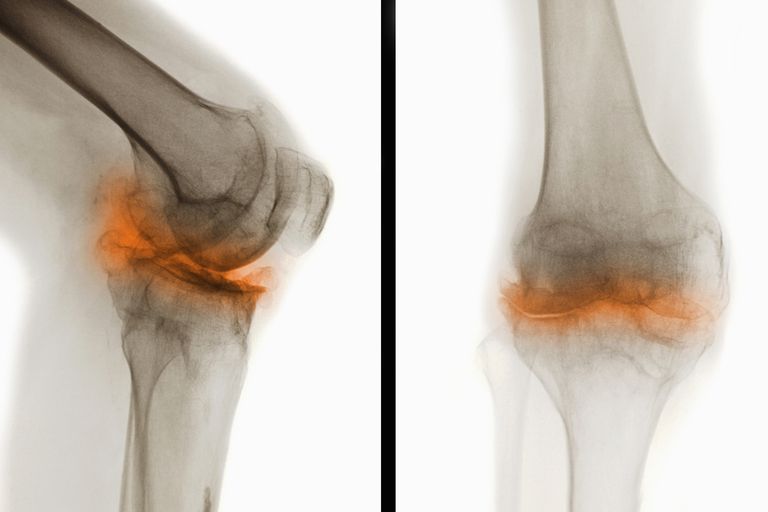 Arthritis Foundation, gøre mere, kalciumkrystaller deres, lindre smerte, påvirker omkring