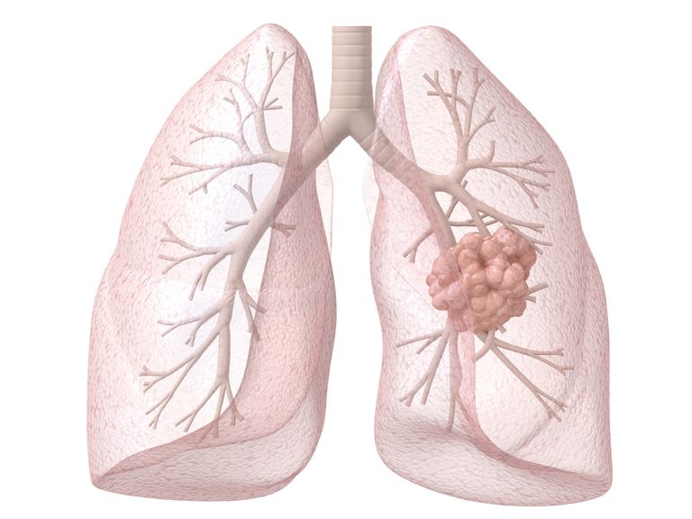 lungekræft tidligere, årsag lungekræft, kræften spredt, lungekræft kvinder