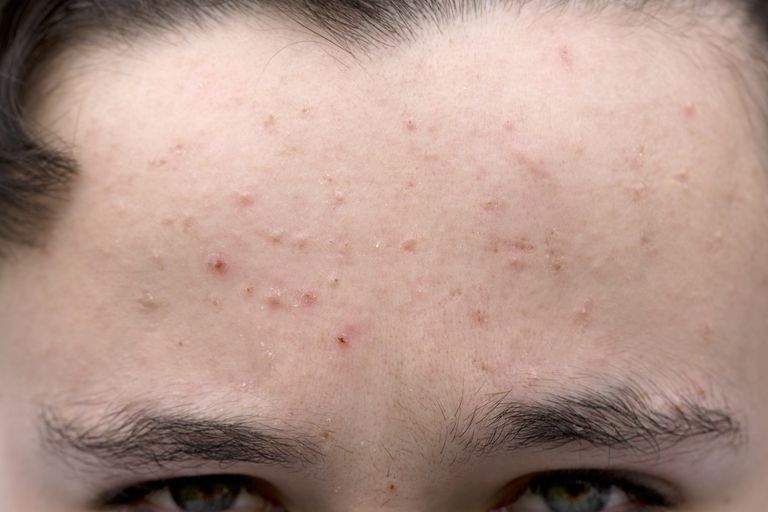 moderat acne, lave aftale, acne Hvis, acne mere, acne udbrud