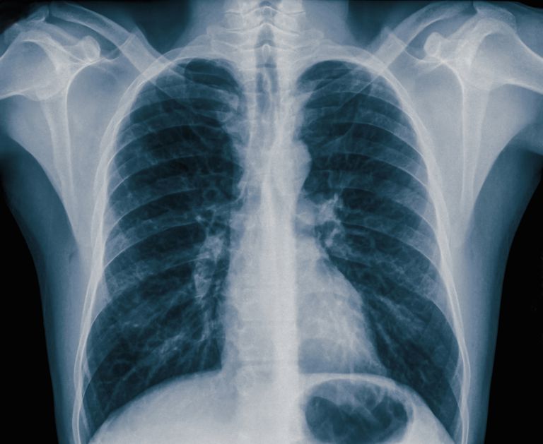 berørte side, lungen brystvæggen, mellem lungen, mellem lungen brystvæggen, nogle tilfælde