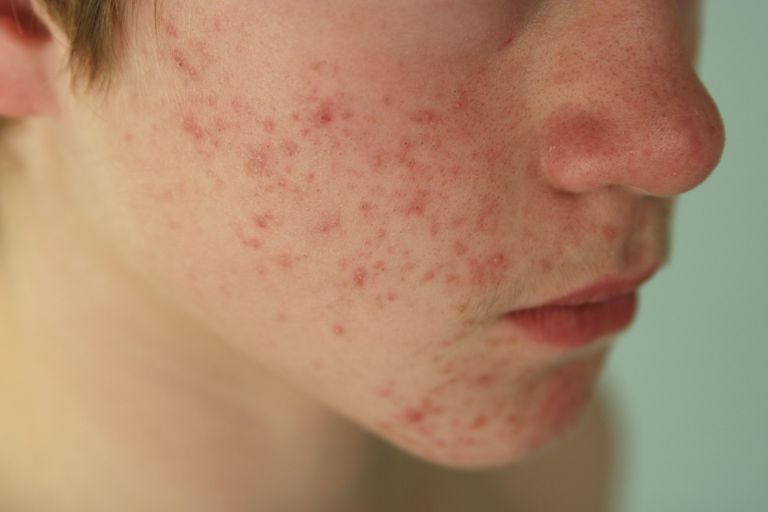 acne vulgaris, forårsager rosacea, voksen acne, acne eller, acne eller rosacea, acne rosacea