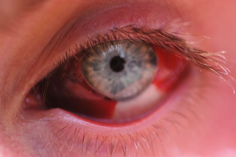 subkonjunktiv blødning, blødning eller, blødning øjet, hvide øjet