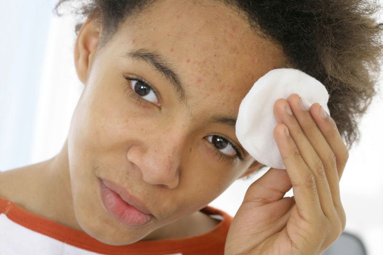 teen acne, acne også, betyder ikke, chokolade eller, godt stykke, godt stykke arbejde