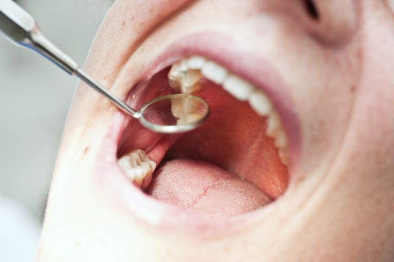 dine tænder, mest almindelige, årsagen tandpine, bemærke dine