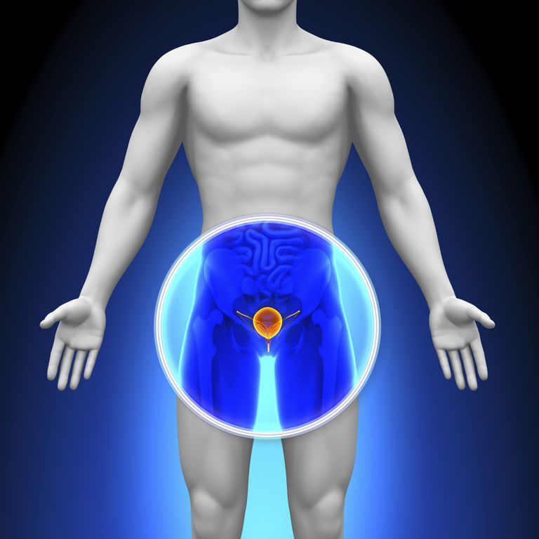 relateret prostatakræft, tidlig stadium, 30cc prostata, avanceret sygdom